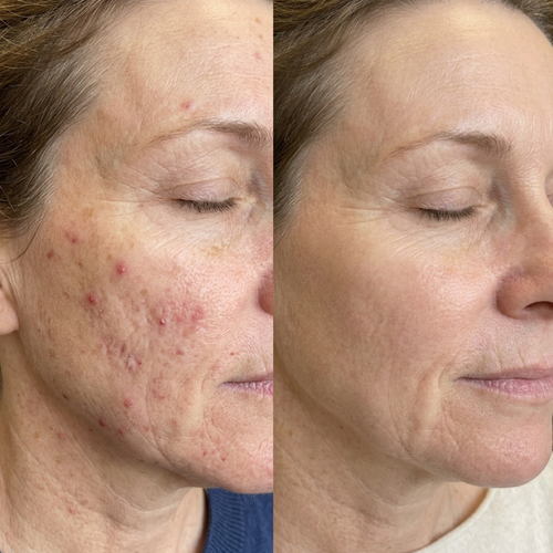 Menopause Acne Gummies